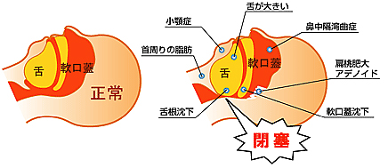 睡眠時無呼吸症候群の原因